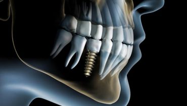 cum obtii un implant dentar